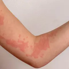 Rote Quaddeln auf einem Arm, die aussehen, als würde man stark frieren.