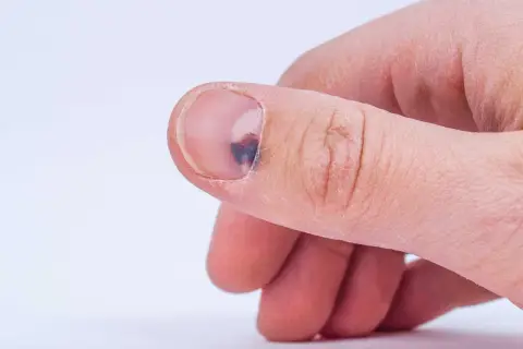 Ein blauer Fleck unter dem Fingernagel, vielleicht durch einen Stoß. Hausmittel können bei solchen Blutergüssen helfen.