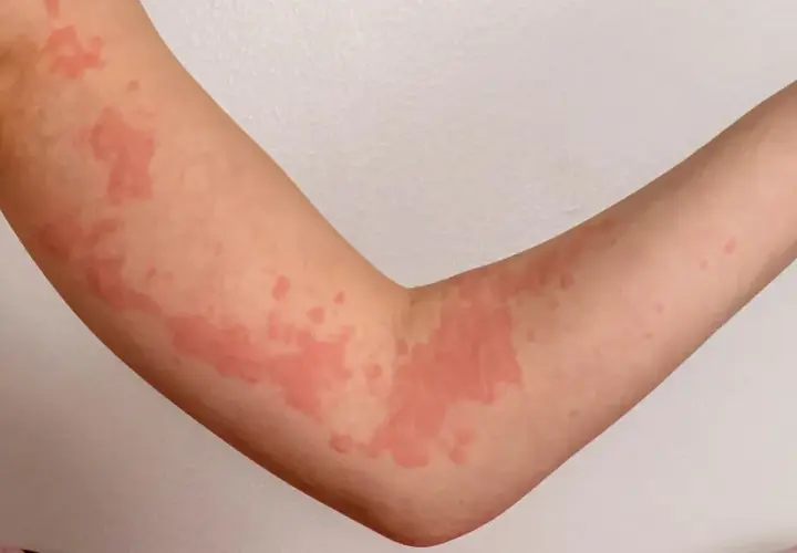 Rote Quaddeln auf einem Arm, die aussehen, als würde man stark frieren.