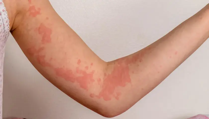 Rote Quaddeln auf einem Arm, die aussehen, als würde man stark frieren.