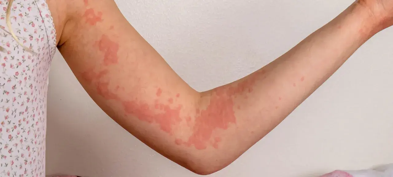 Rote Quaddeln auf einem Arm, die aussehen, als würde man stark frieren.