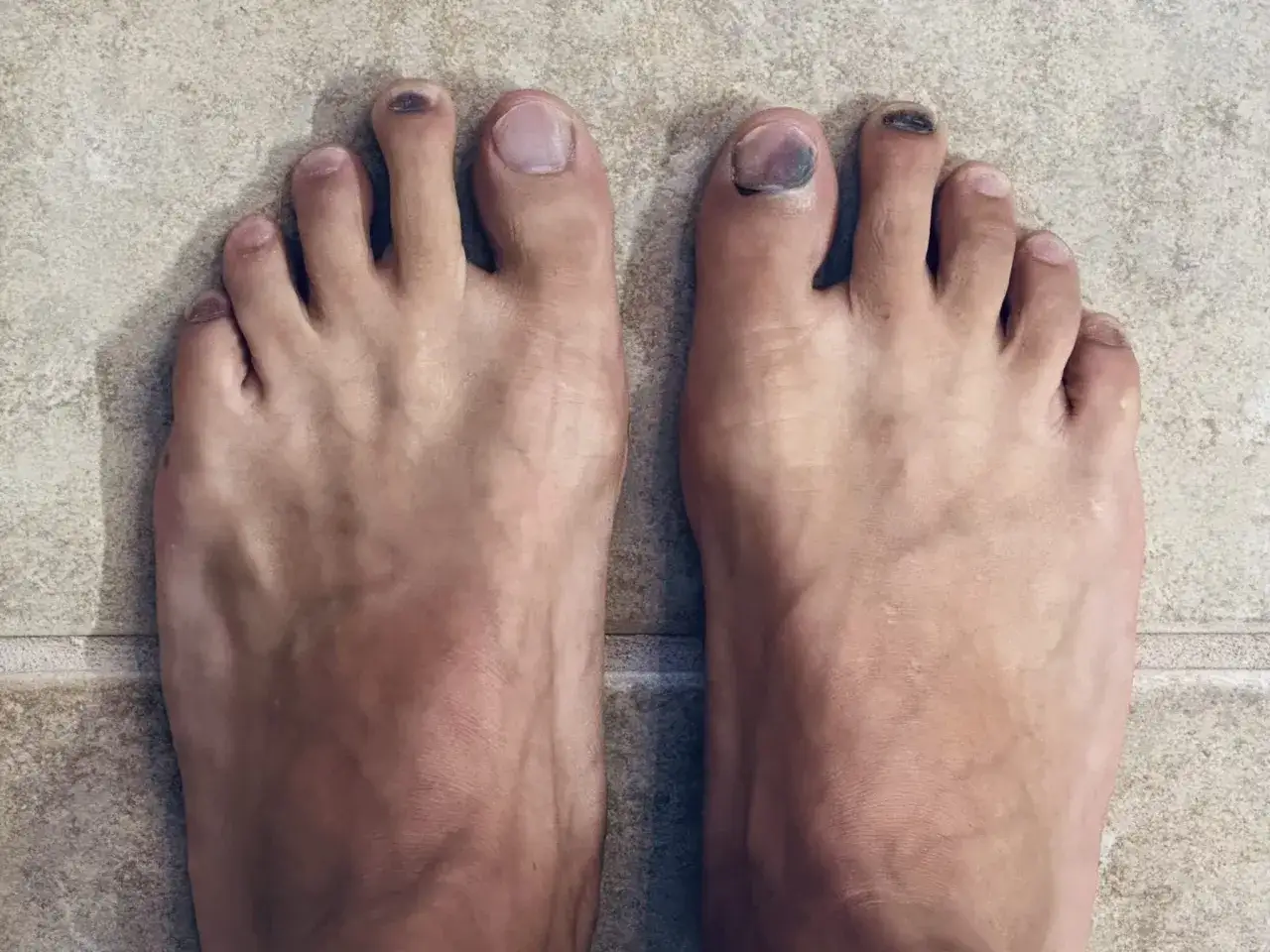 Zeigt F&uuml;&szlig;e mit dunklen Zehenn&auml;geln, ein klassisches Zeichen f&uuml;r einen runners toe nach einem langen Lauf.